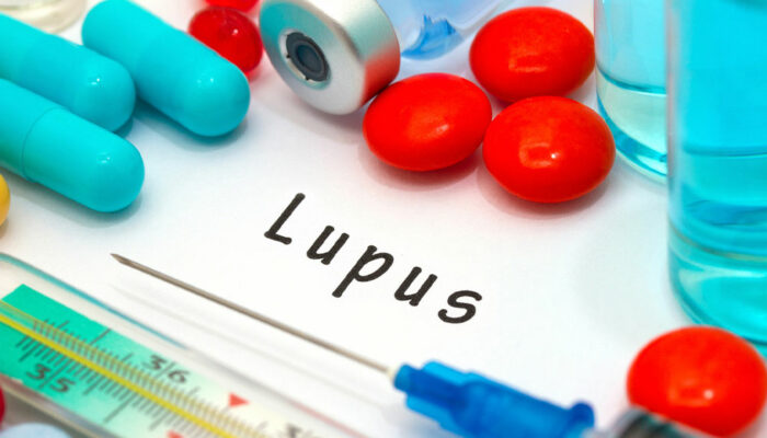 General Procedures Involved in Lupus Management