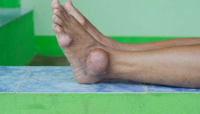 Gout attacks and their treatment procedures