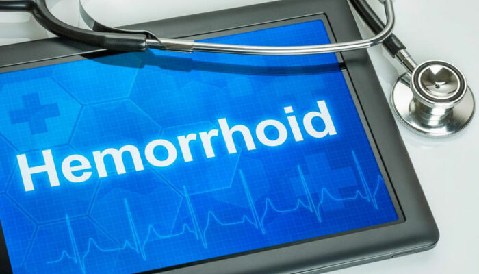 Hemorrhoids: What they are and their causes