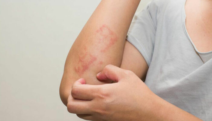 Here&#8217;s all that you need to know about scabies skin rash