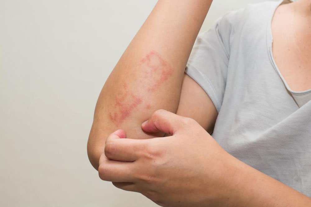 Here&#8217;s all that you need to know about scabies skin rash