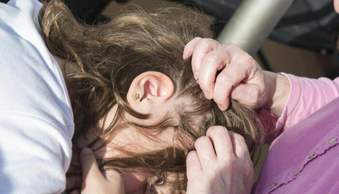 Home remedies for treating head lice