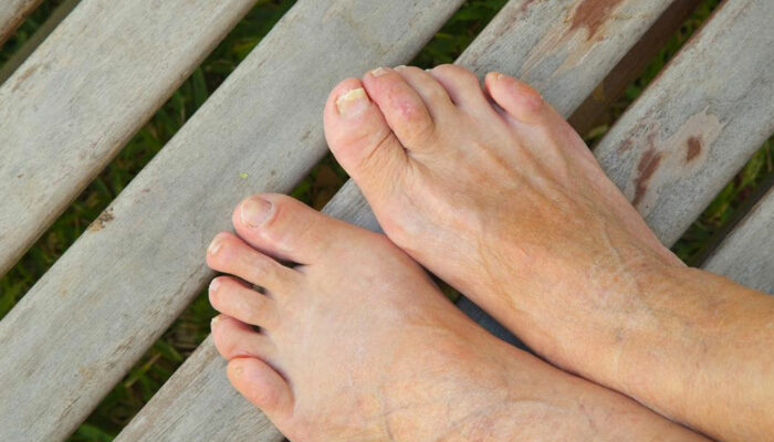 Home remedies for curing toenail fungus