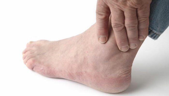 Home treatment for relief from gout foot pain