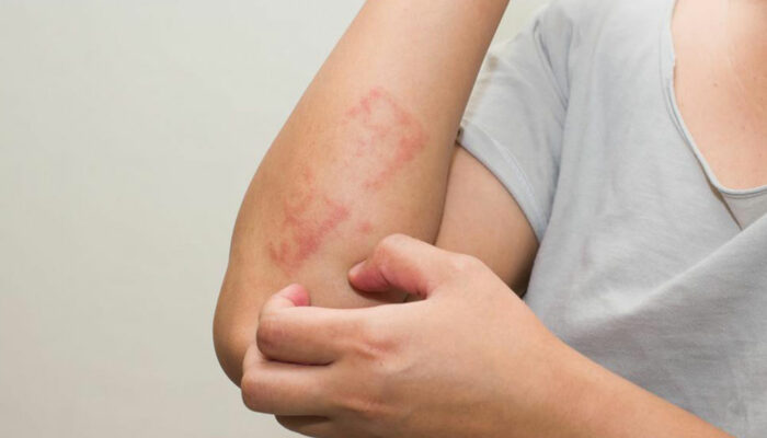 How to identify and treat poison ivy rash with daily use products