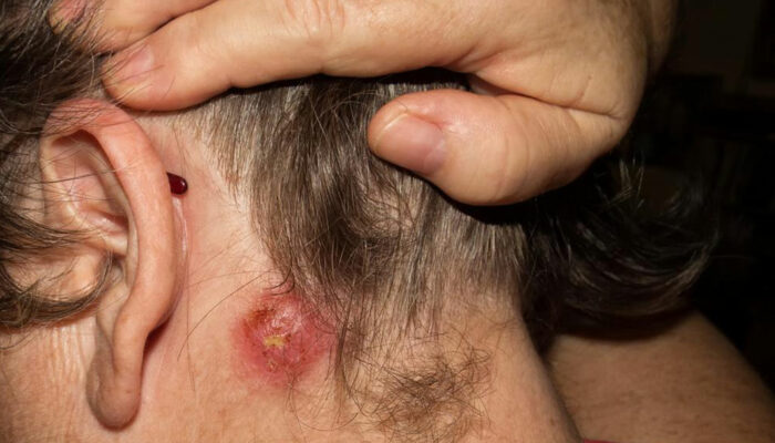 How can you spot the signs of staph infection