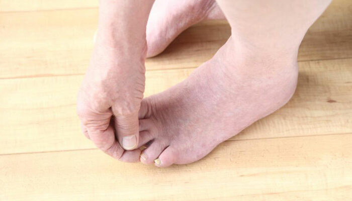 Important things to know about toenail fungus