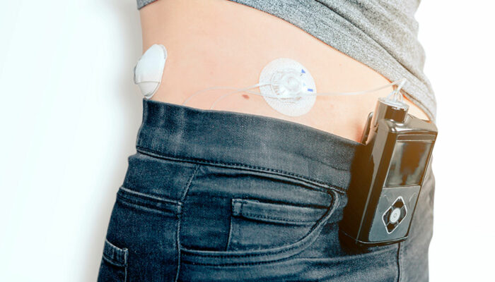 Insulin pumps &#8211; 3 best devices to buy in 2021