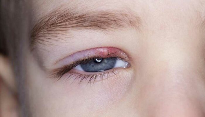 Know about the Symptoms and Causes of Eyelid Inflammation