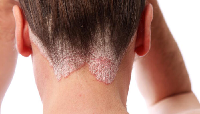 Know the skin ailment: Scalp psoriasis