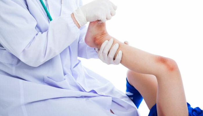 Medical treatment to heal a bruise quickly