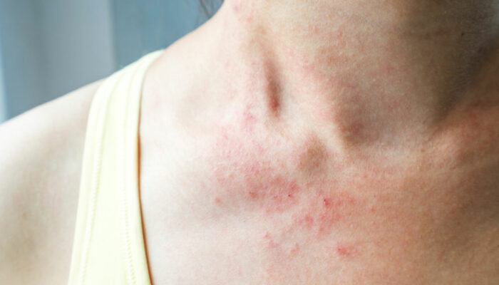 Mycosis fungoides &#8211; more than just a skin rash