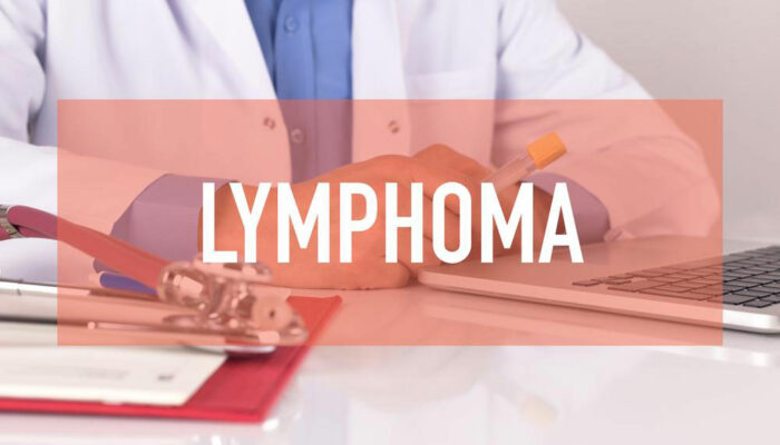 Non Hodgkin Lymphoma treatment &#8211; Symptoms, causes and more explained