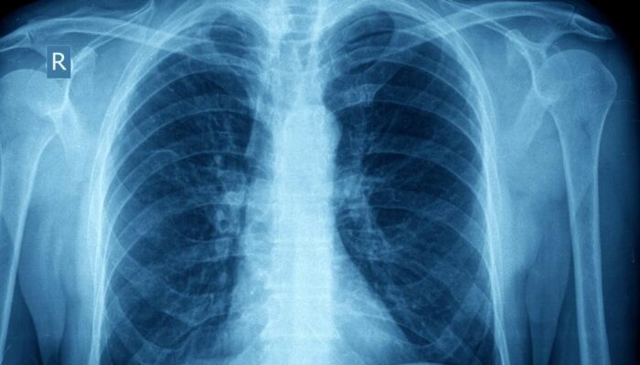 Pathology and Pathophysiology of Asthma