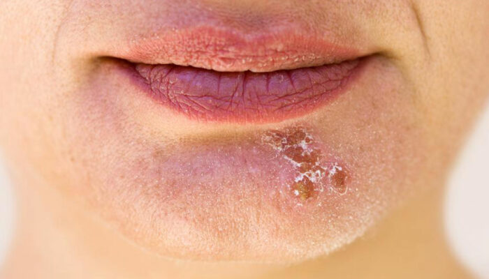 Popular essential oils to bid goodbye to cold sores