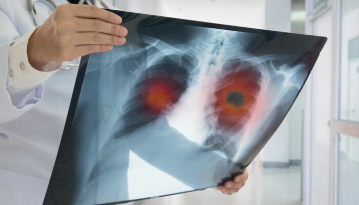 Popular treatment options for metastatic lung cancer