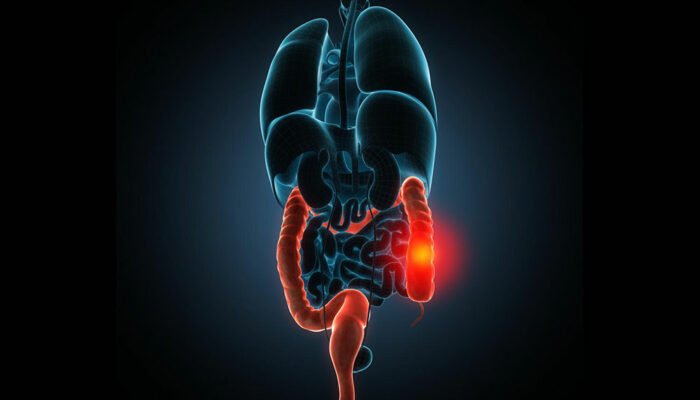 Popular treatments for irritable bowel syndrome