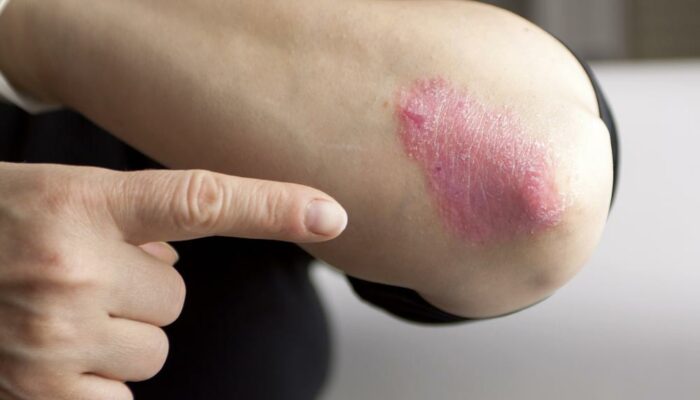 Psoriasis Symptoms