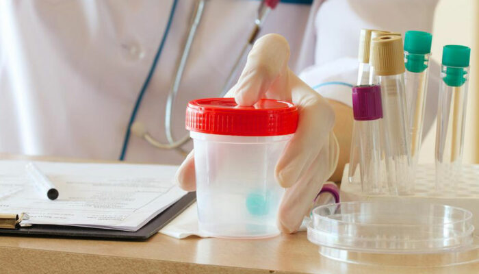 Proteinuria &#8211; The process of protein in urine test