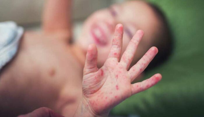 Prevention Tips for Hand, Foot, and Mouth Disease