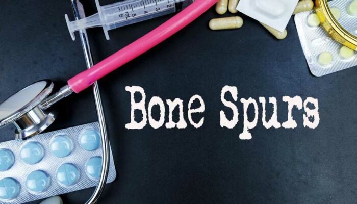 Prevention and Treatment for Bone Spurs