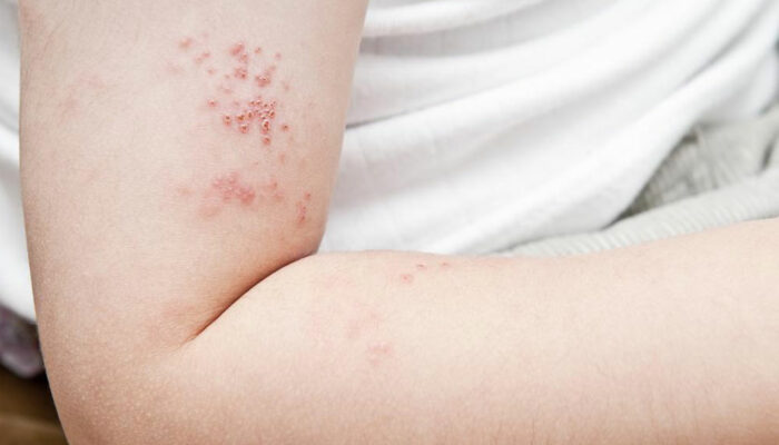 Prevent yourself from shingles before it infects you