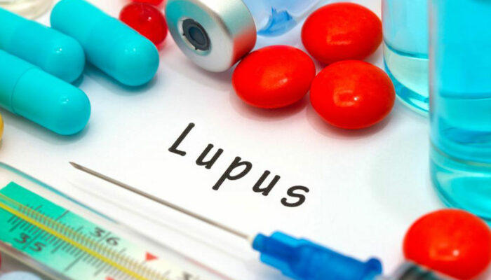 Remedies for Lupus