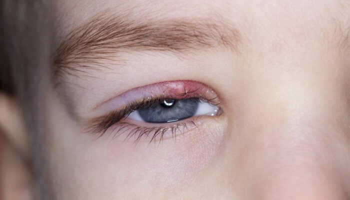 Remedies to get rid of stye