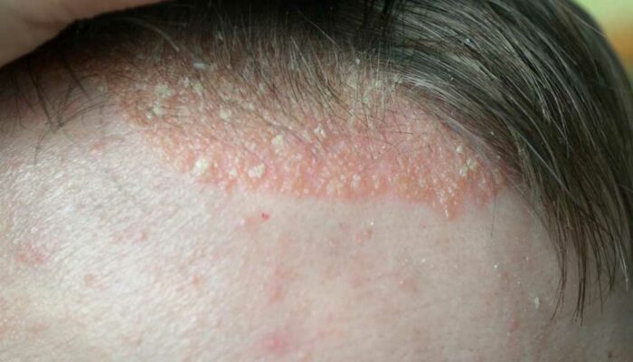 Scalp Psoriasis &#8211; Symptoms to Watch out For