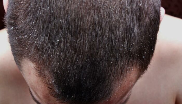 Scalp Psoriasis