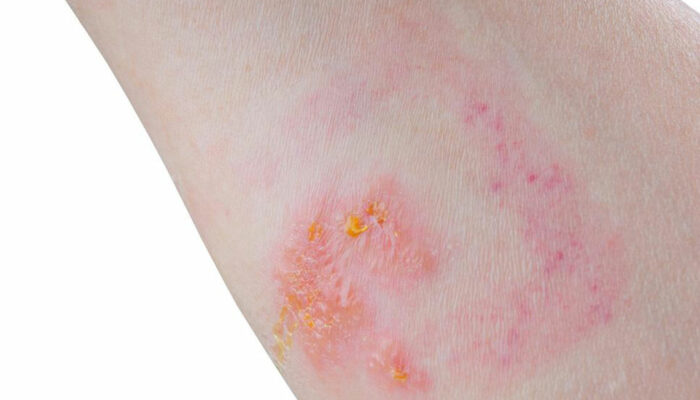 Skin Rash: Which condition is it?