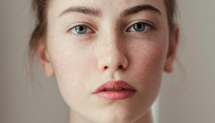 Simple home remedies for freckles