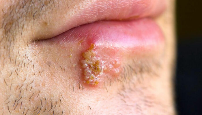 Signs that tell you might have herpes