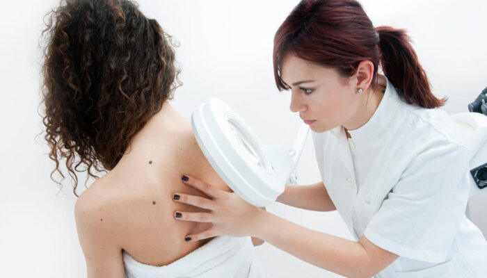 Stage four melanoma, symptoms and treatment