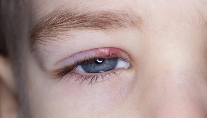 The 4 common causes of blepharitis