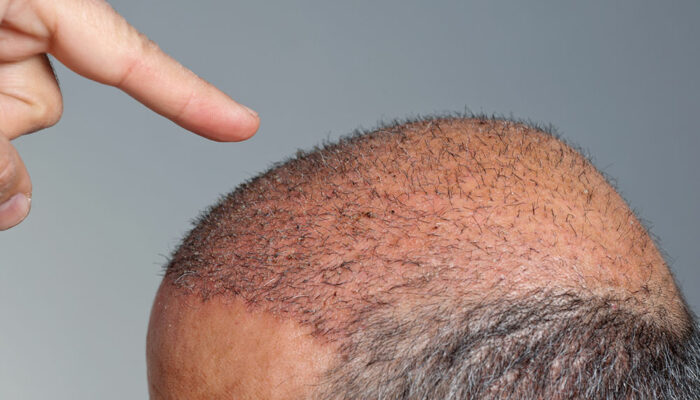 The truth about how much hair transplants cost