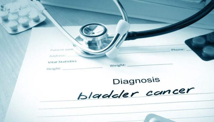 The Common Causes of Bladder Cancer