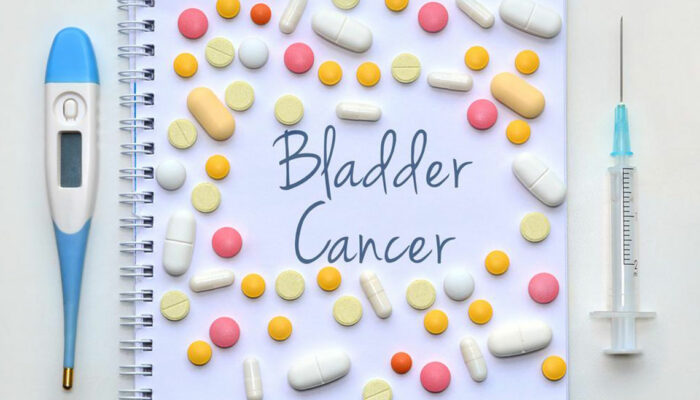 Things to know about the different stages of bladder cancer