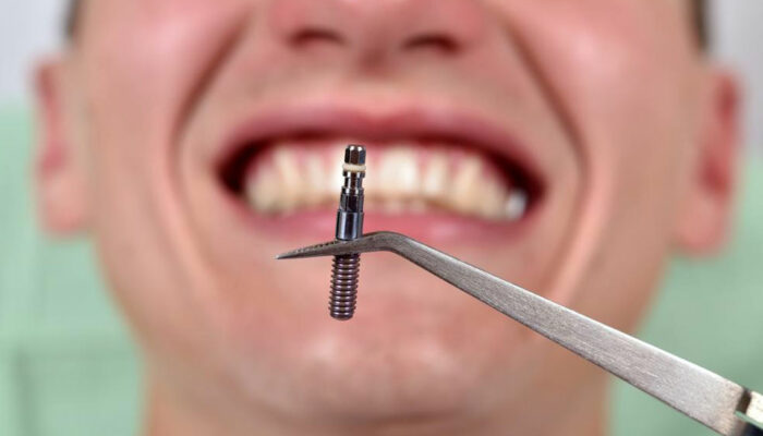 Things you should know about dental implants costs