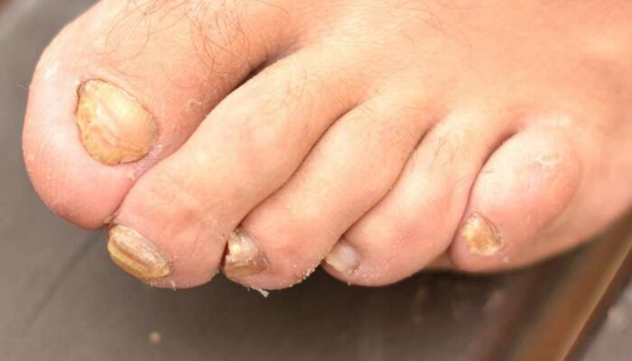 Tips to Treat Nail Fungus Effectively