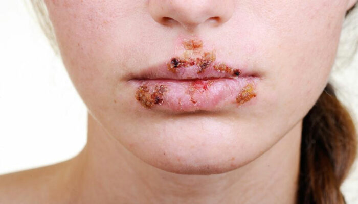 Tips to manage herpes outbreak