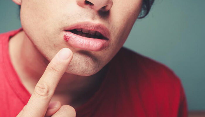 Top 4 FAQs about cold sores