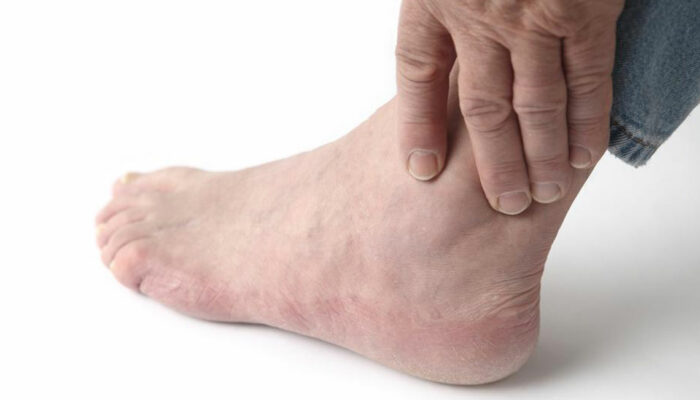 Top Causes of Swollen Ankles