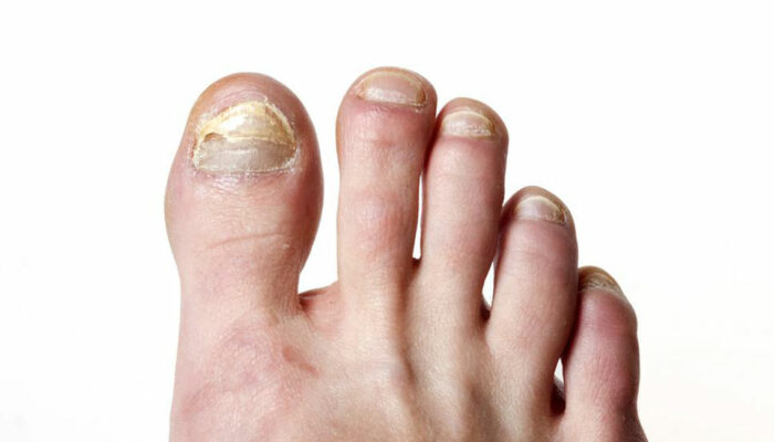 Top signs of toe nail fungus