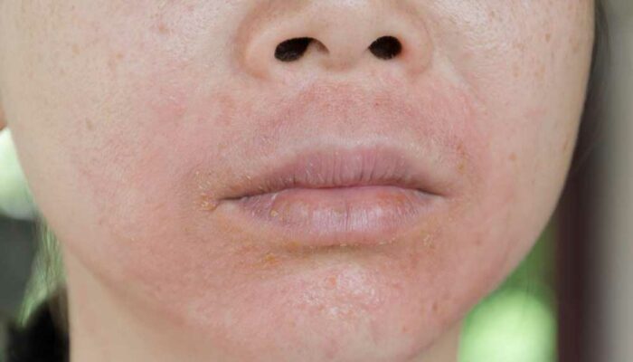 Treatment Methods for Lupus Skin Rashes