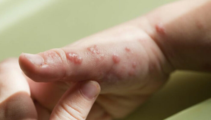 Treatment for symptoms of viral infections