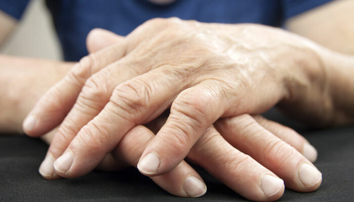 Treatment options and medications for managing rheumatoid arthritis