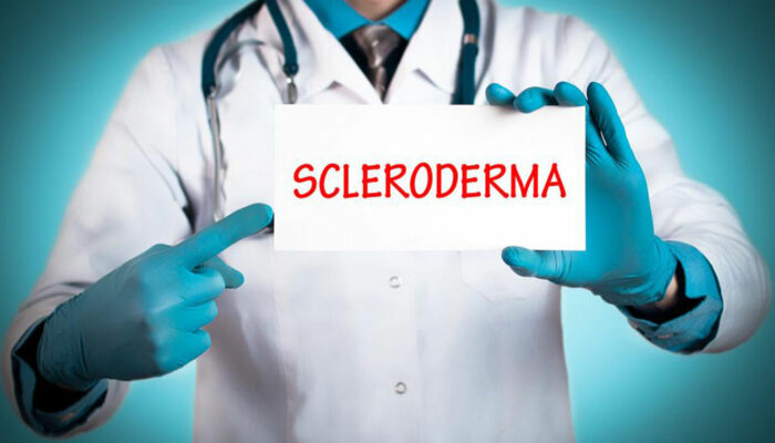 Treating the early symptoms of scleroderma