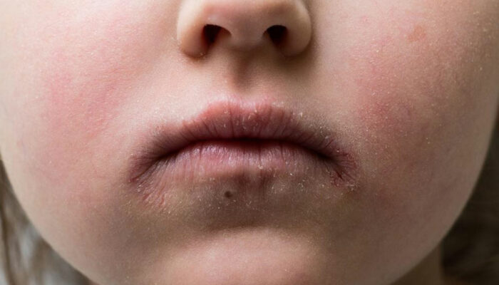 Understanding the causes of impetigo in children and adults