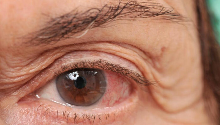 Ways of dealing with chronic dry eye disease